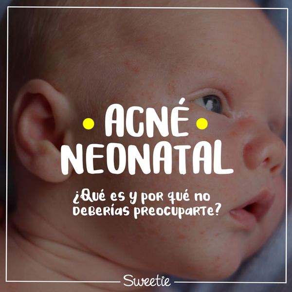 Acné neonatal: ¿qué es y por qué no deberías preocuparte?